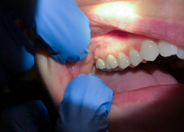 Best Emergency Gum Treatment in Lordship, CT